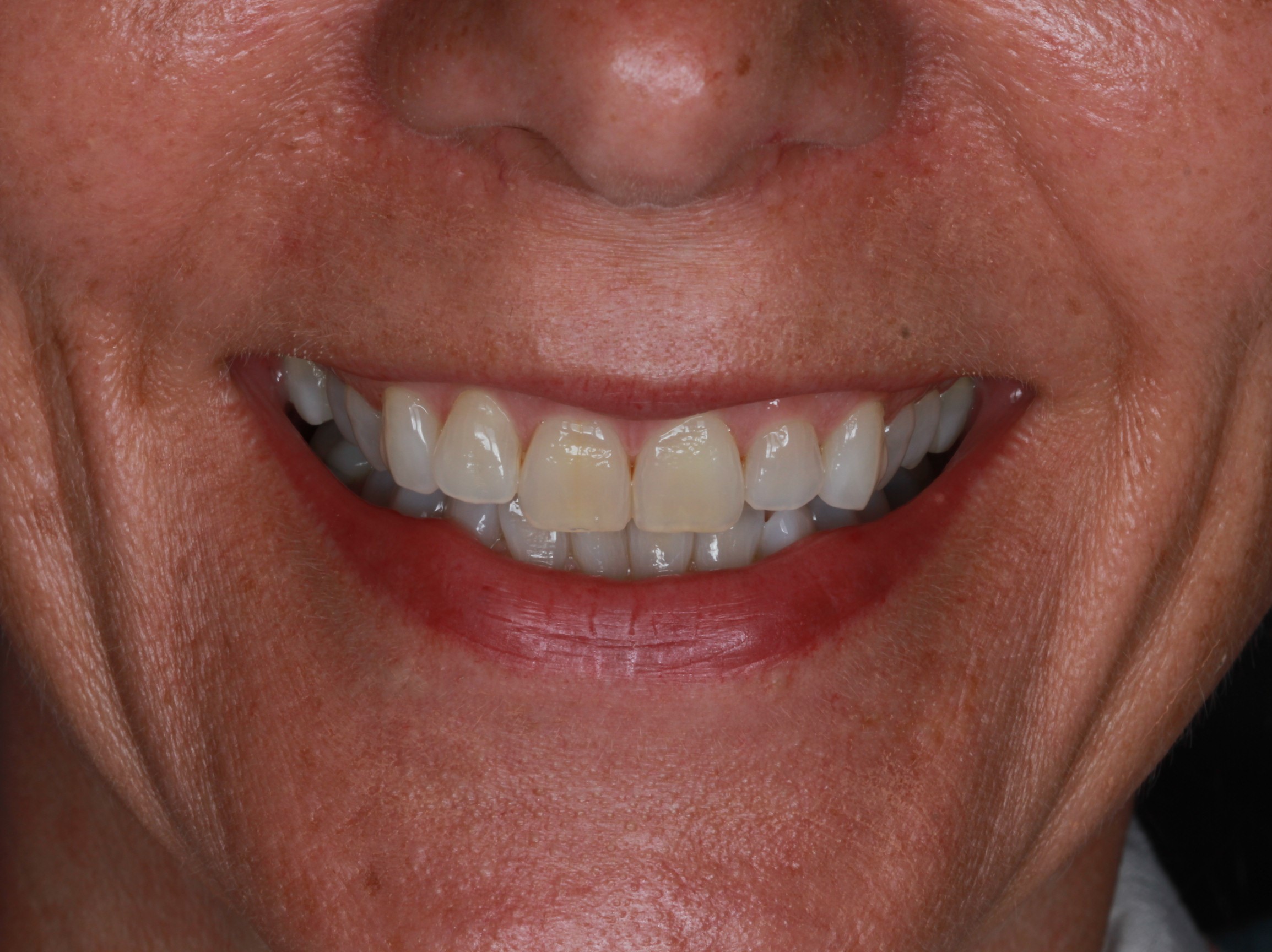 Before treatment: deep bite with the upper front teeth overlapping and hiding the lower incisors