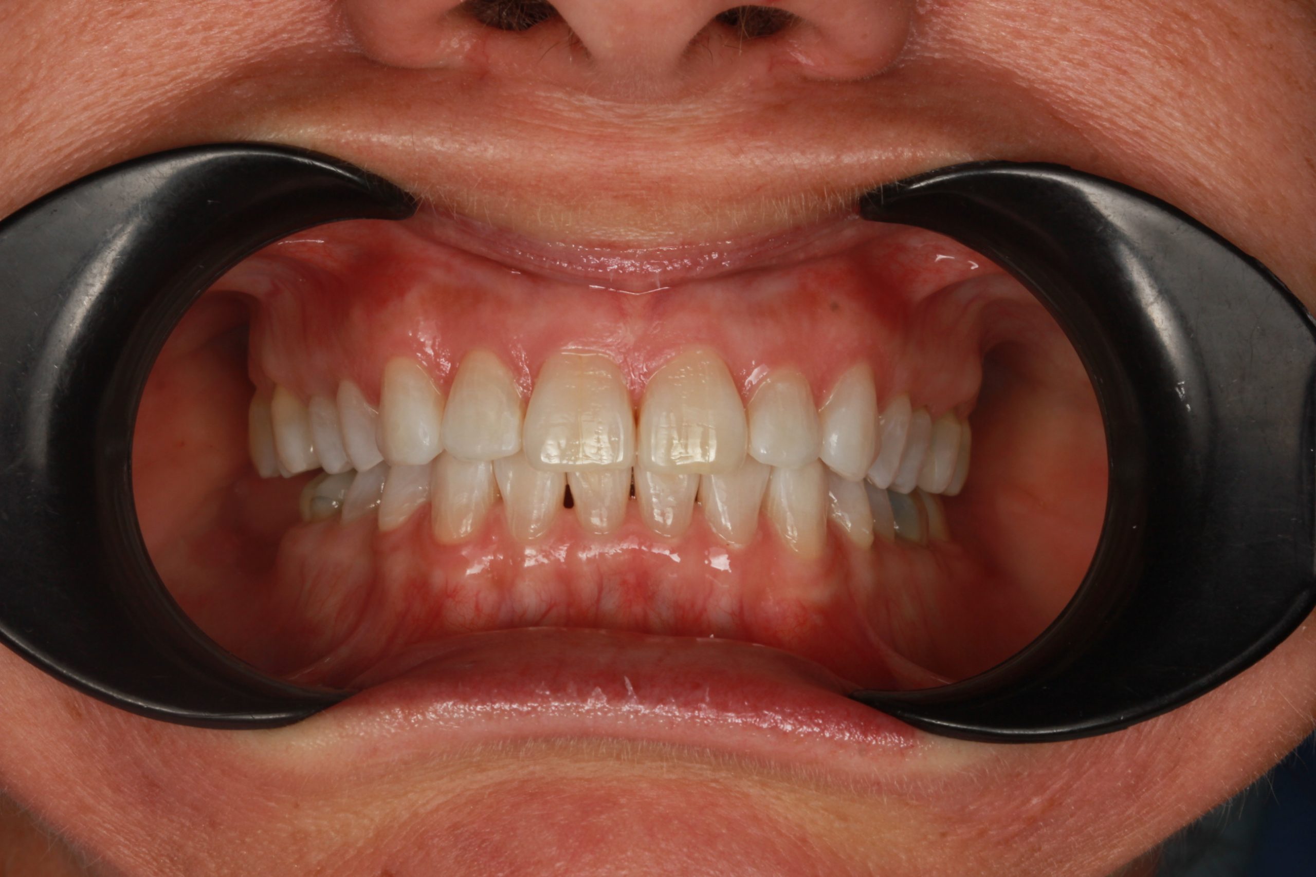 After treatment: lower incisor crowding fully resolved