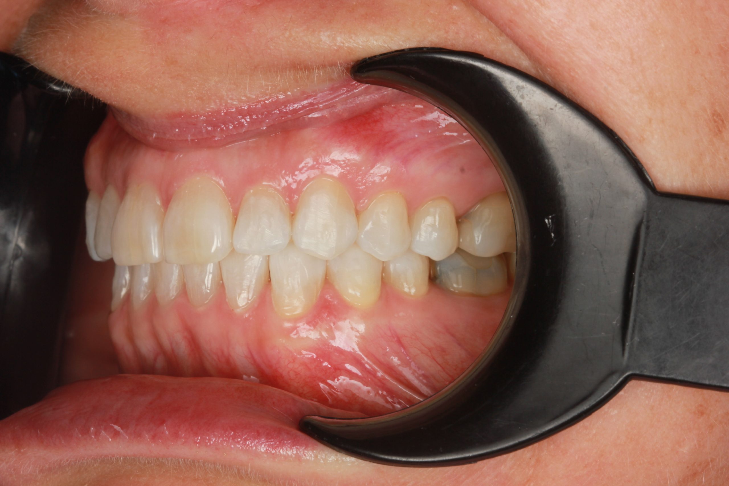 After treatment: upper right lateral incisor aligned with the adjacent teeth