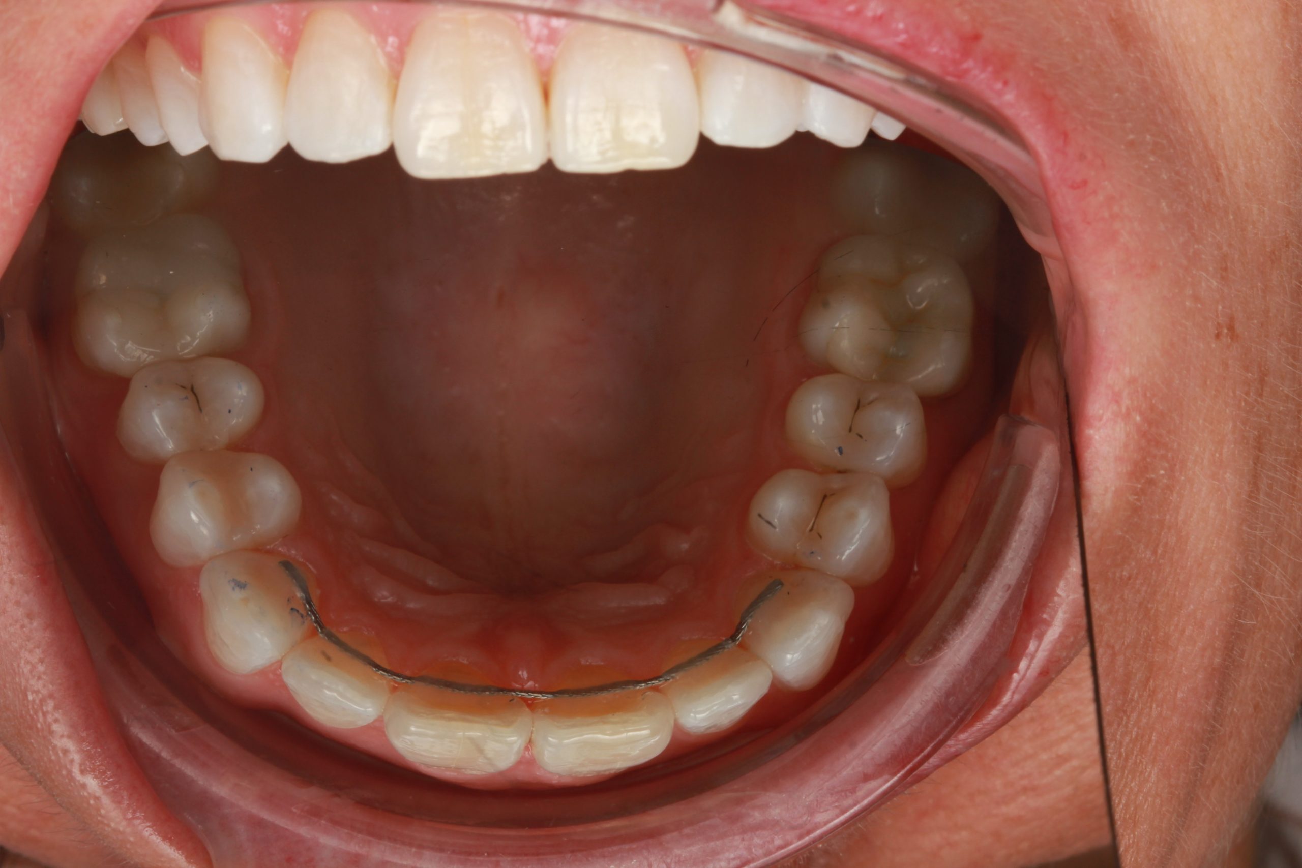 After treatment: fuller, wider and more symmetrical smile with reduced dark corners