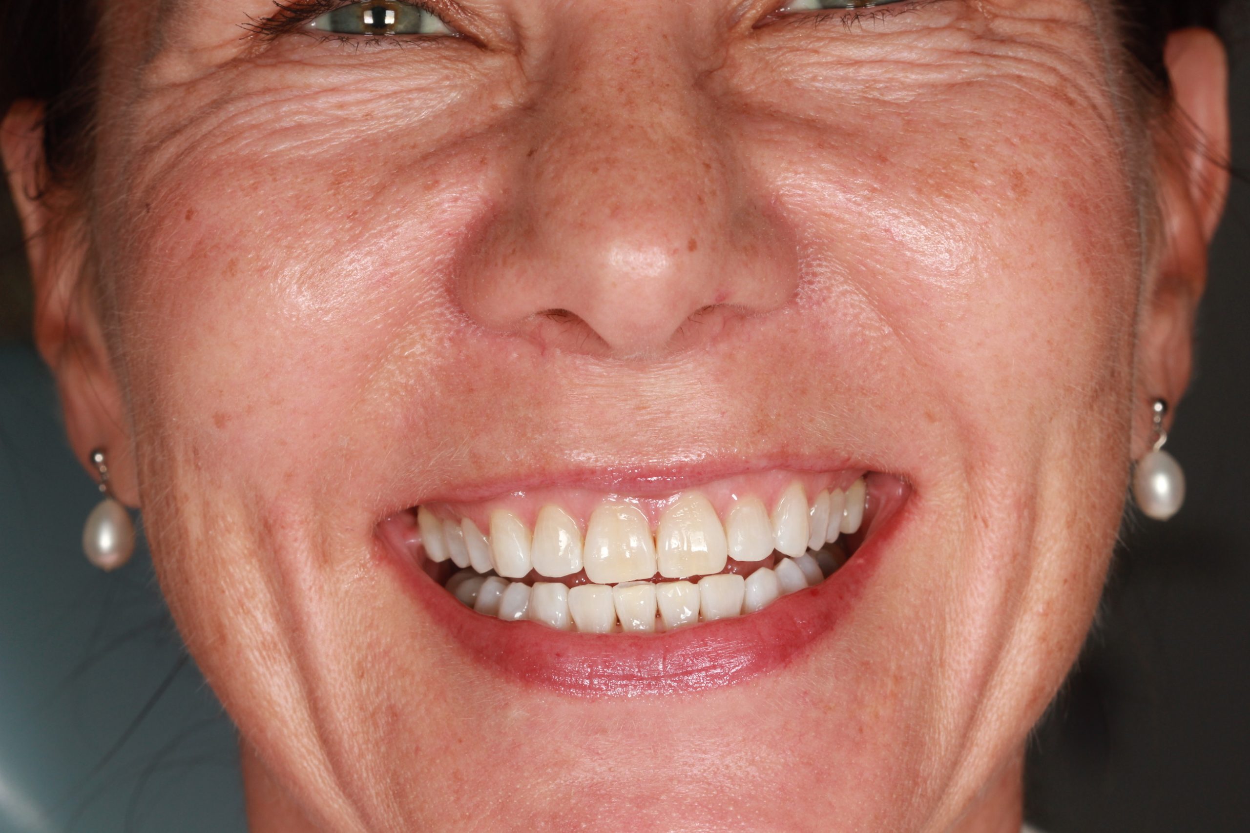 After treatment: reduced deep bite with the lower incisors visible and both arches aligned