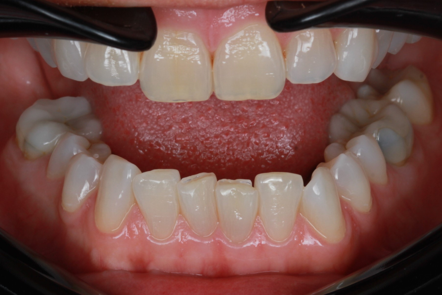Before treatment: crowded and overlapping lower front teeth