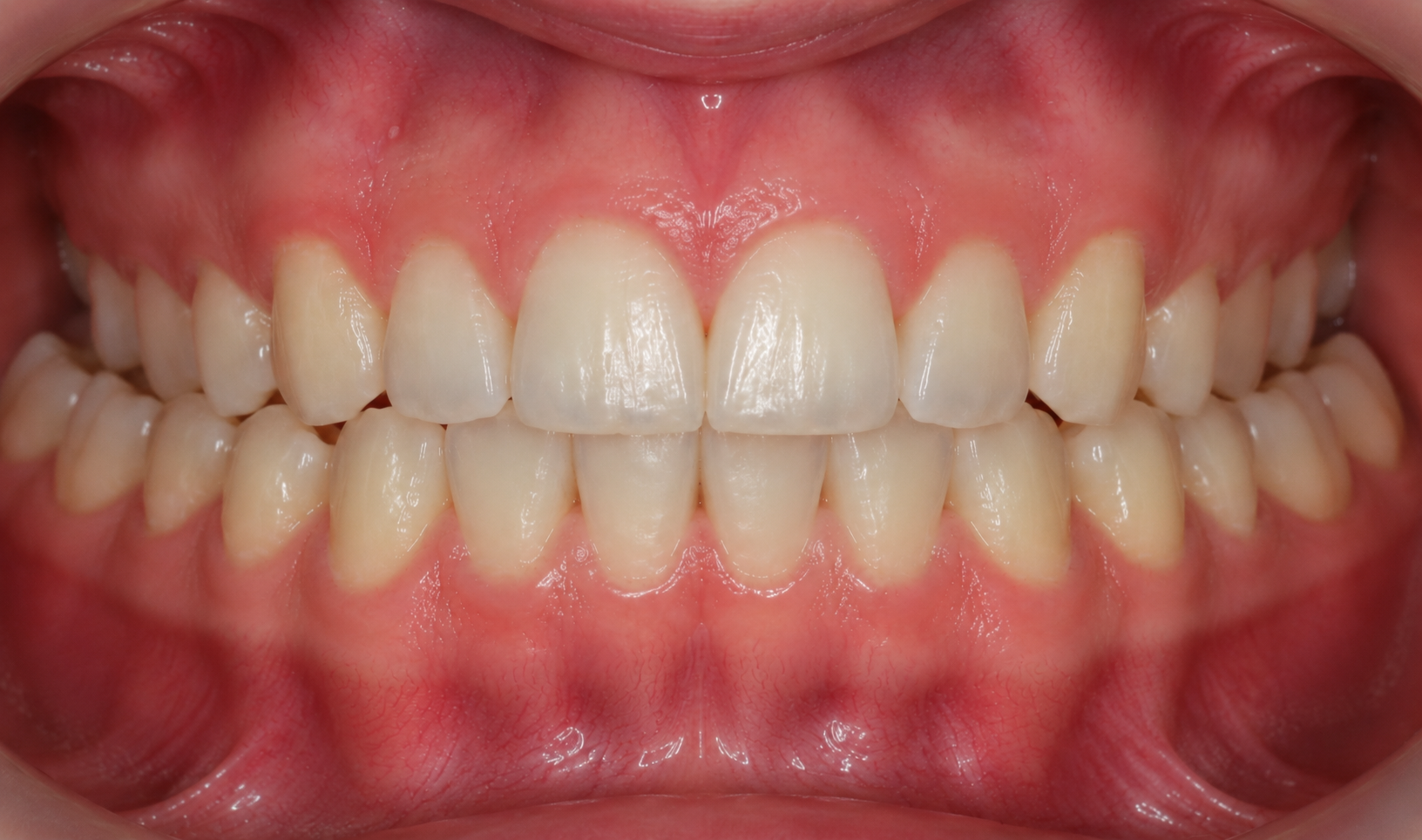 Front close-up of a smile showing spacing and gaps between the teeth