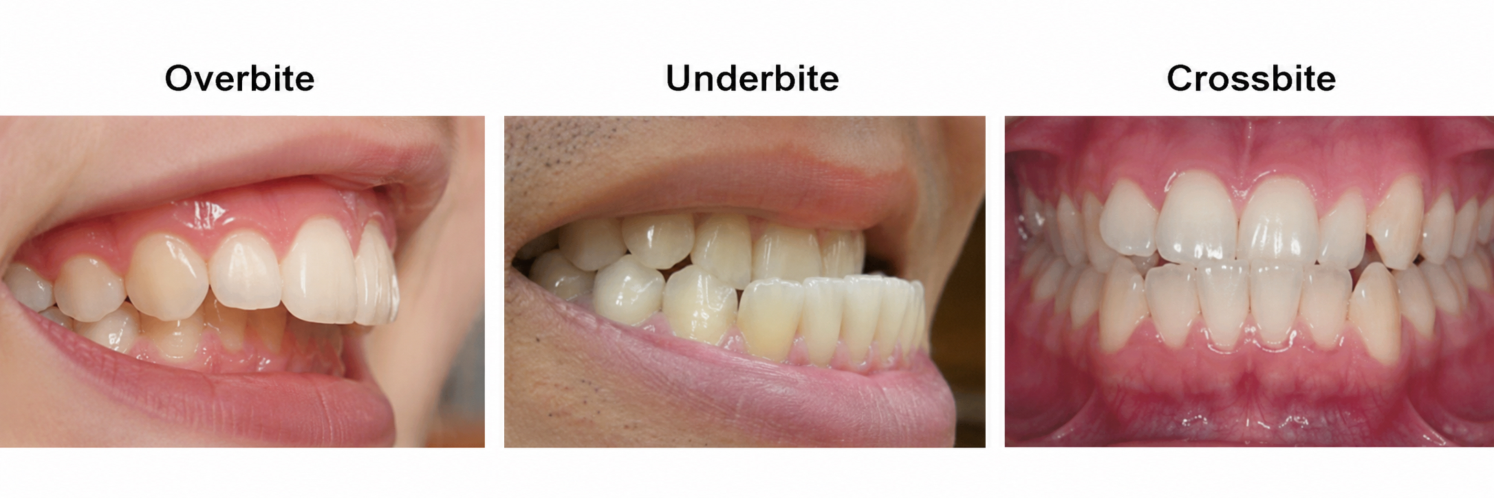 Front view of crowded, overlapping teeth before orthodontic bite correction