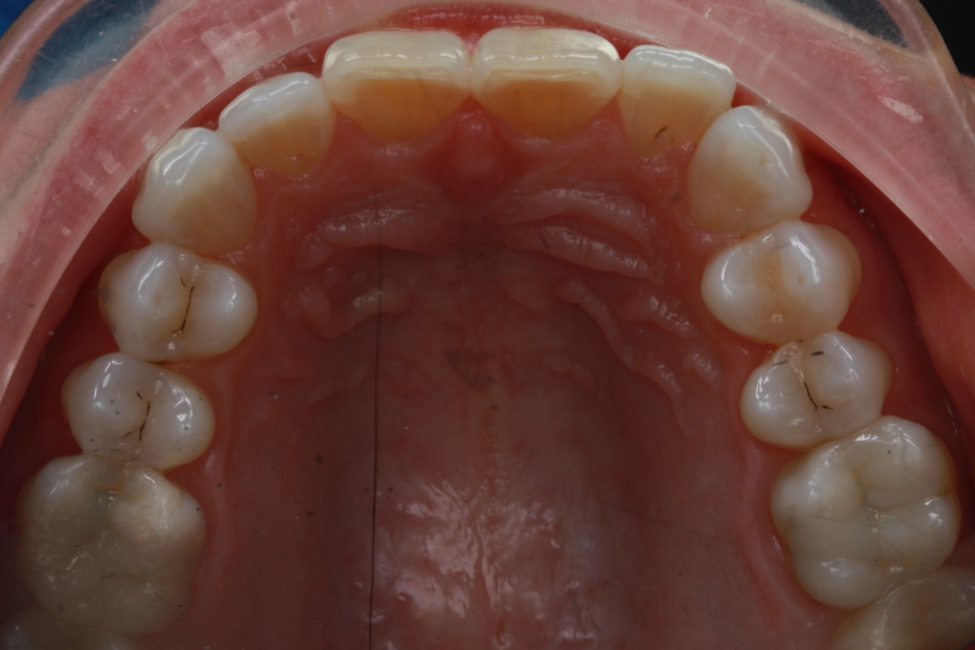 Before treatment: narrow smile with dark buccal corridors at the corners