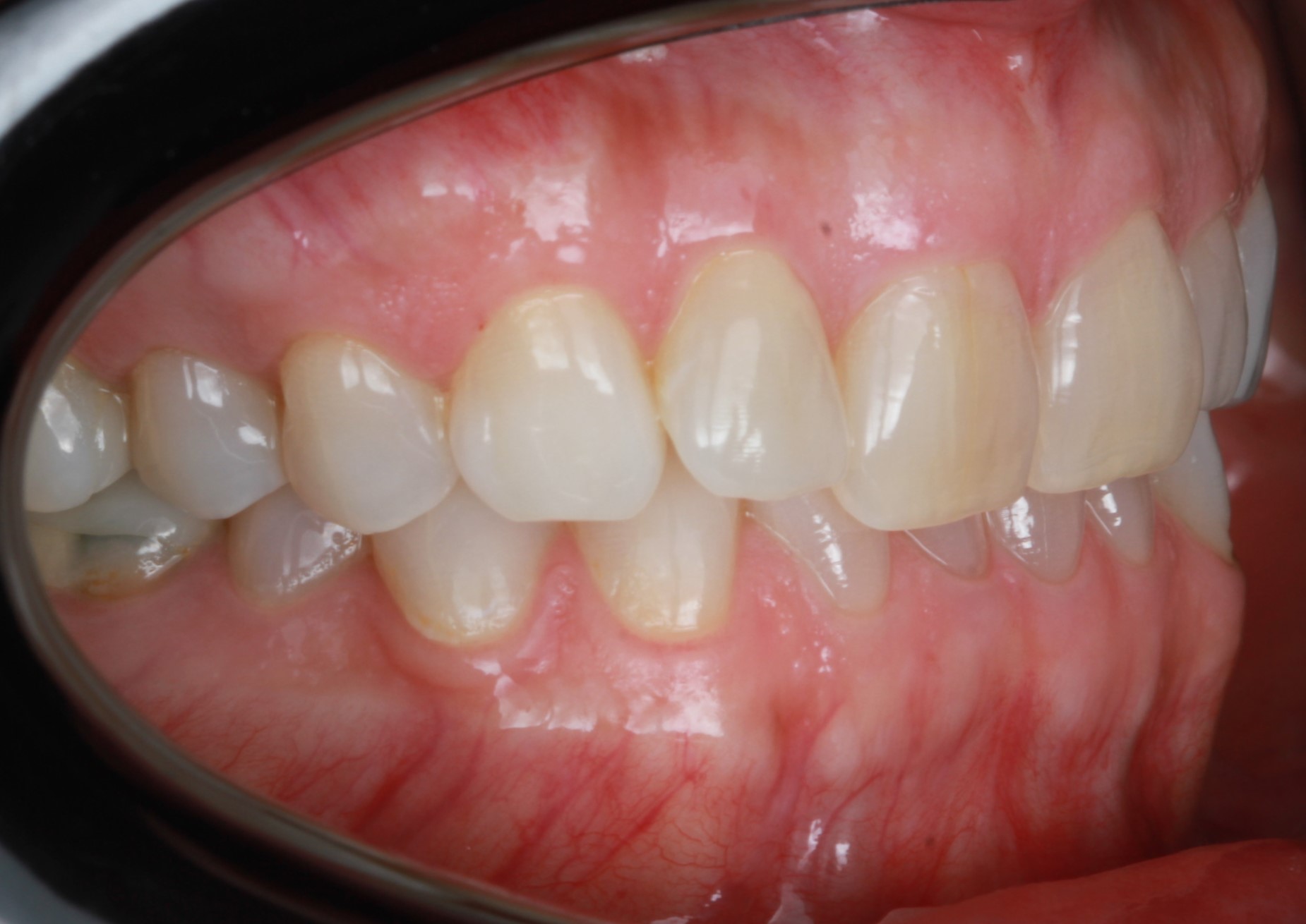 Before treatment: prominent upper right lateral incisor sitting forward of the neighbouring teeth