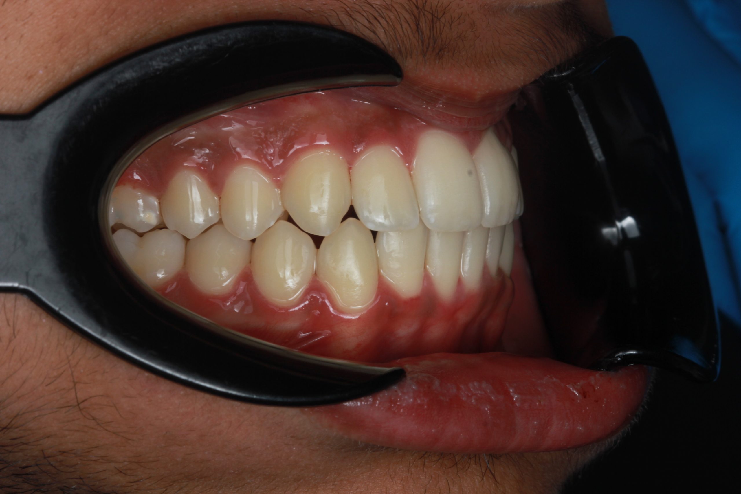After treatment - lateral retracted view showing aligned teeth
