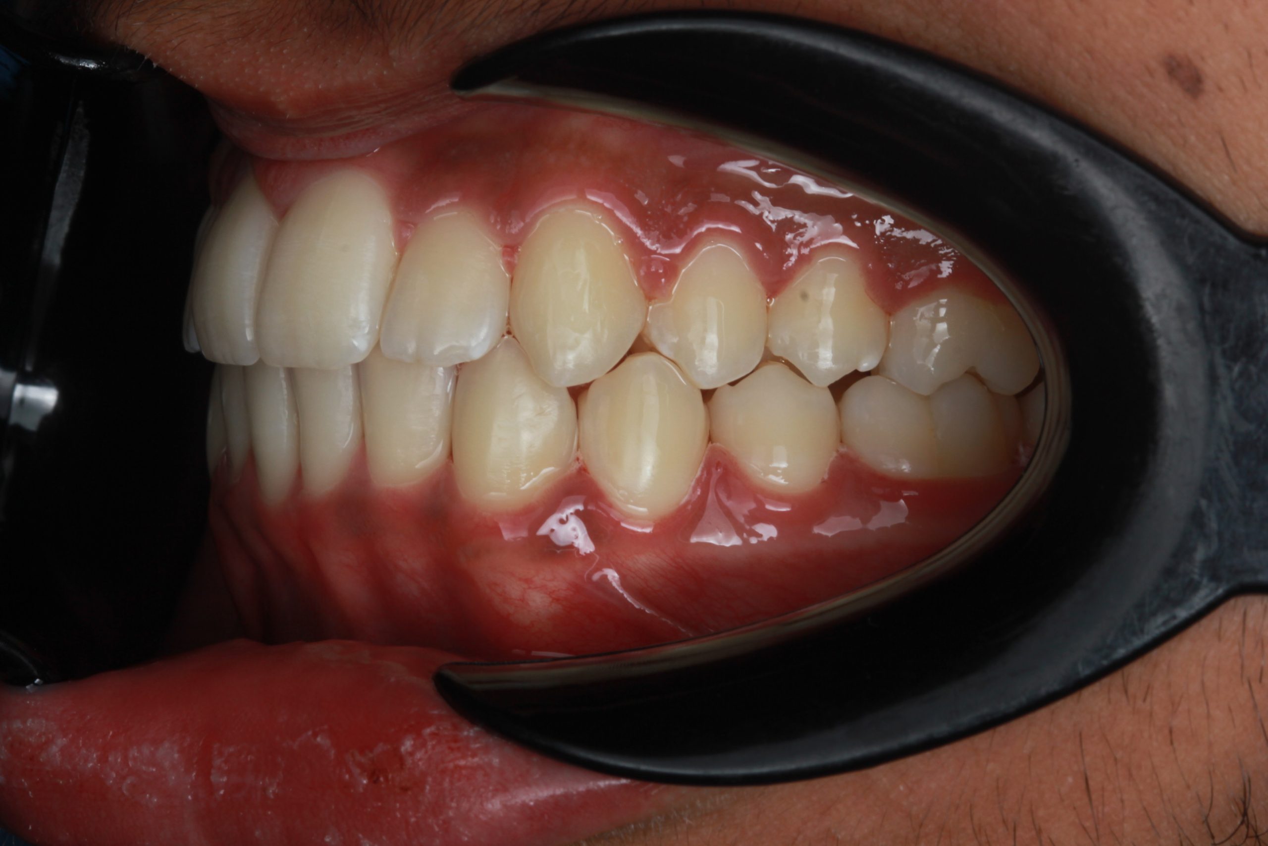 After treatment - buccal view showing corrected bite