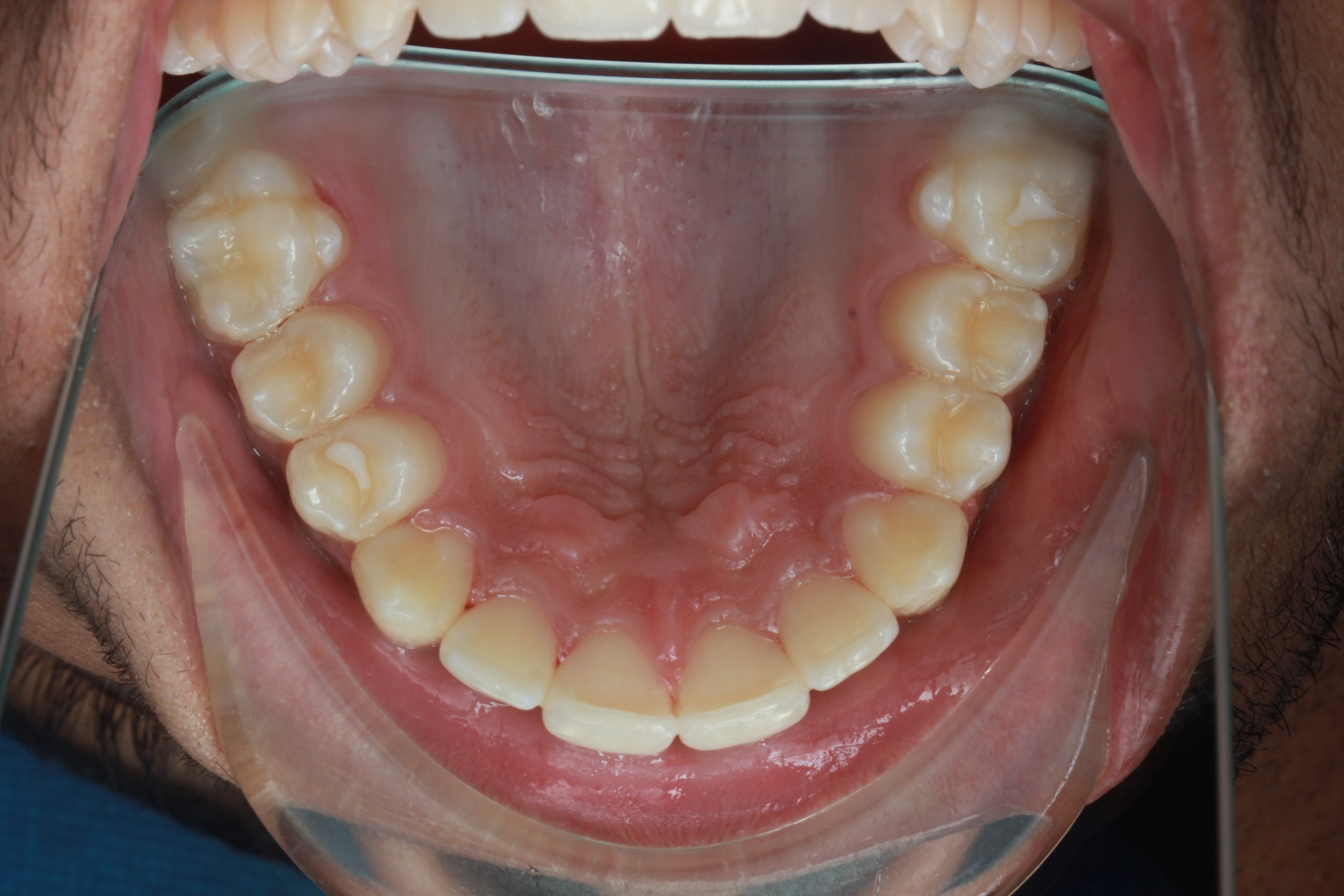 After treatment - upper occlusal view showing a widened arch