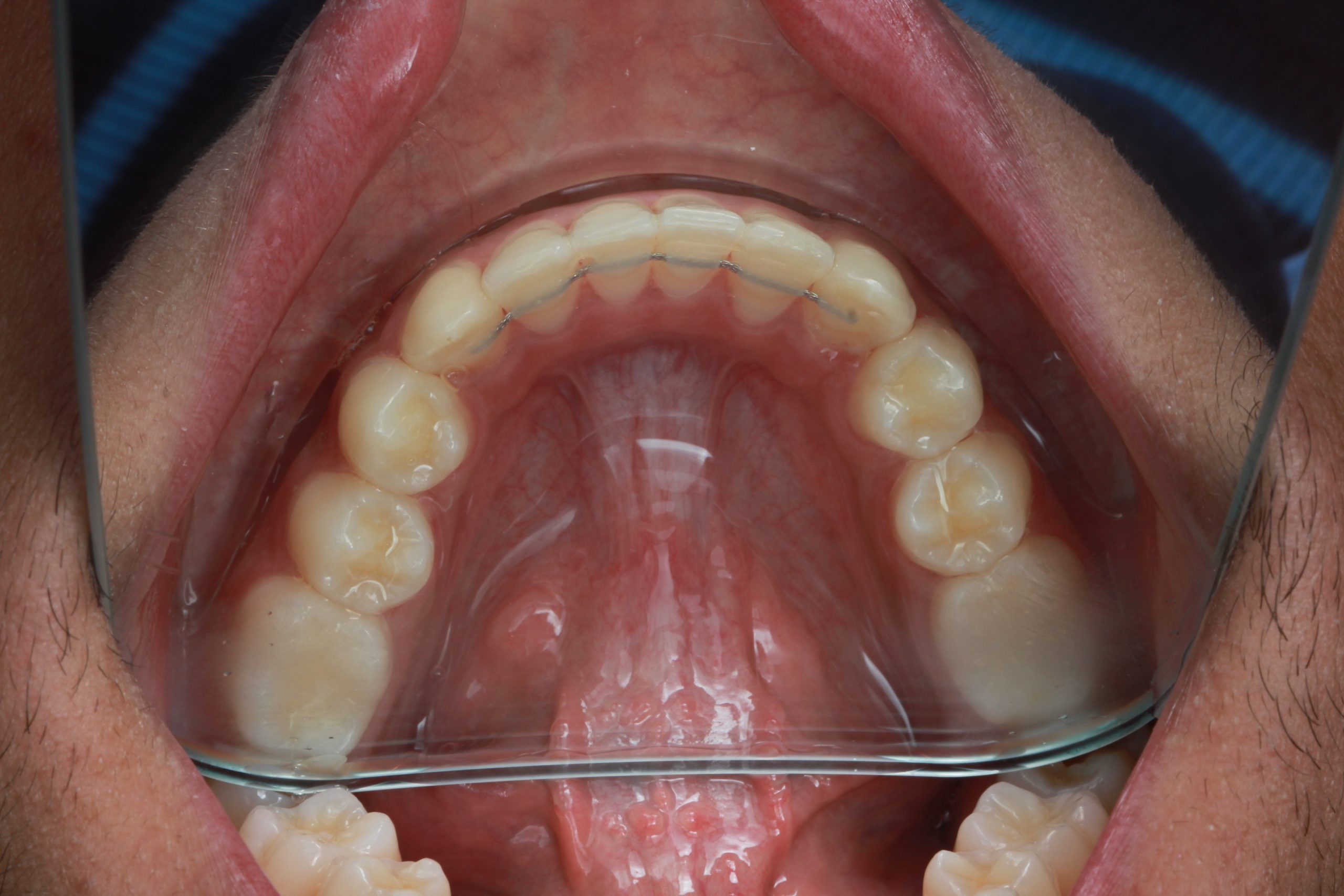 After treatment - lower occlusal view showing resolved crowding and bonded retainer