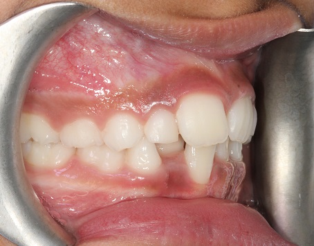Before treatment - frontal retracted view showing crowding and the ectopic lower incisor