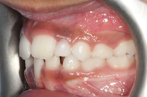 Before treatment - buccal view