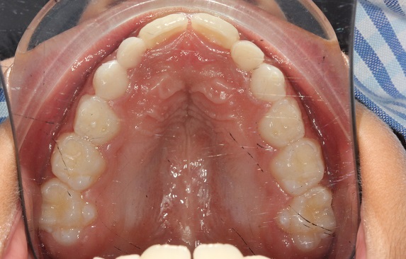 Before treatment - upper occlusal view showing a constricted arch