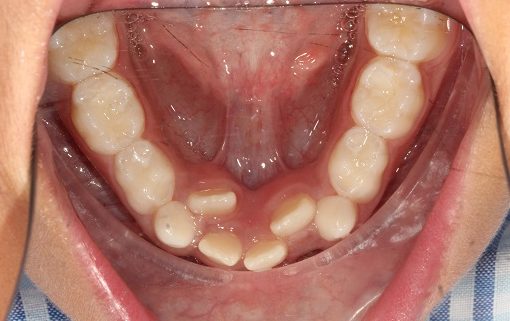 Before treatment - lower occlusal view showing severe crowding