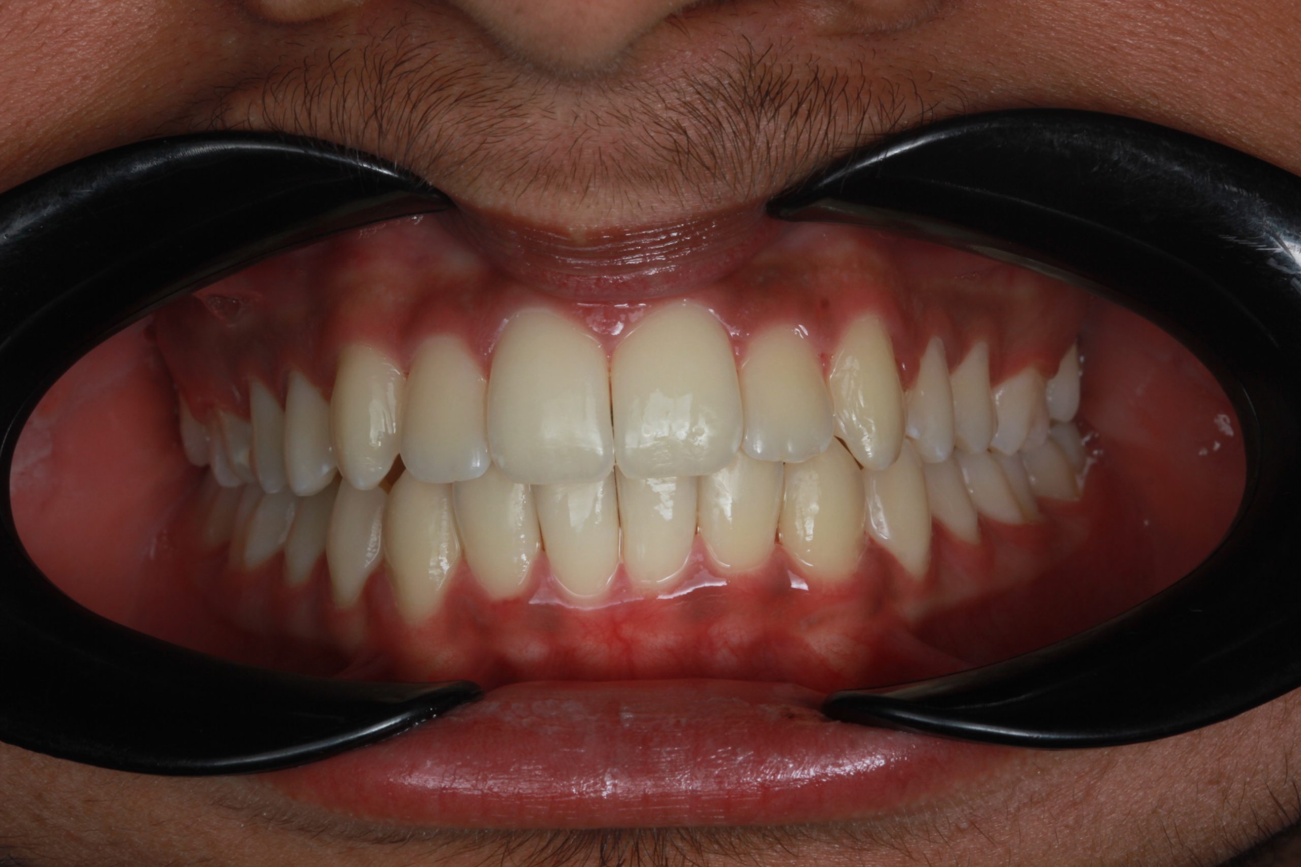 Final result - overview smile photo, front view