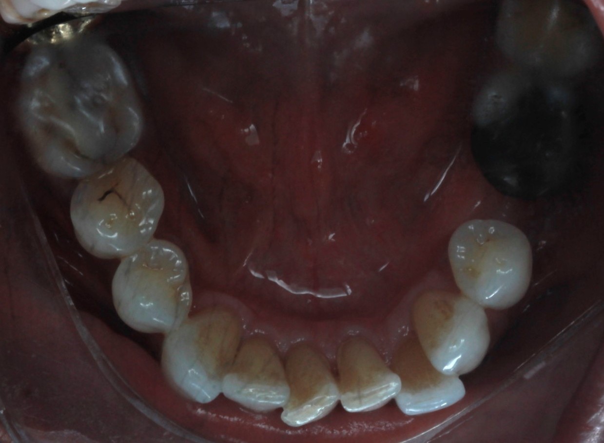 Occlusal view of the lower arch after treatment