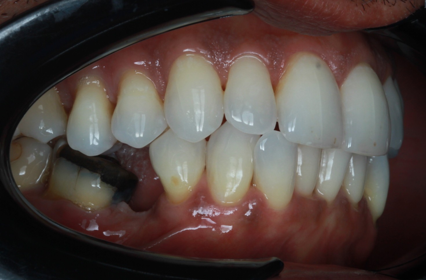 Post-treatment intraoral frontal view showing corrected bite relationship