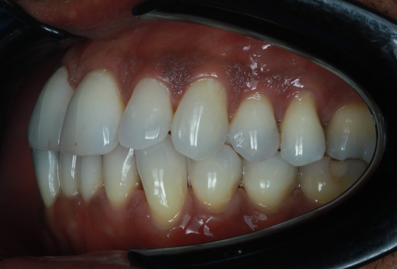 Post-treatment intraoral view confirming corrected crossbite