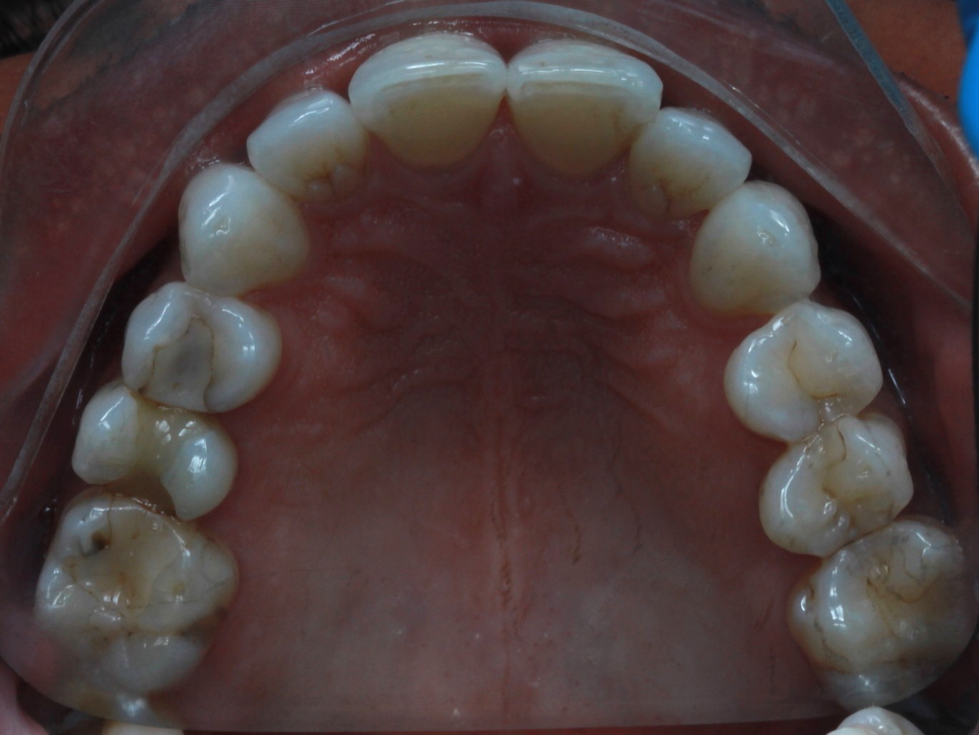 Occlusal view of the upper arch after Invisalign treatment