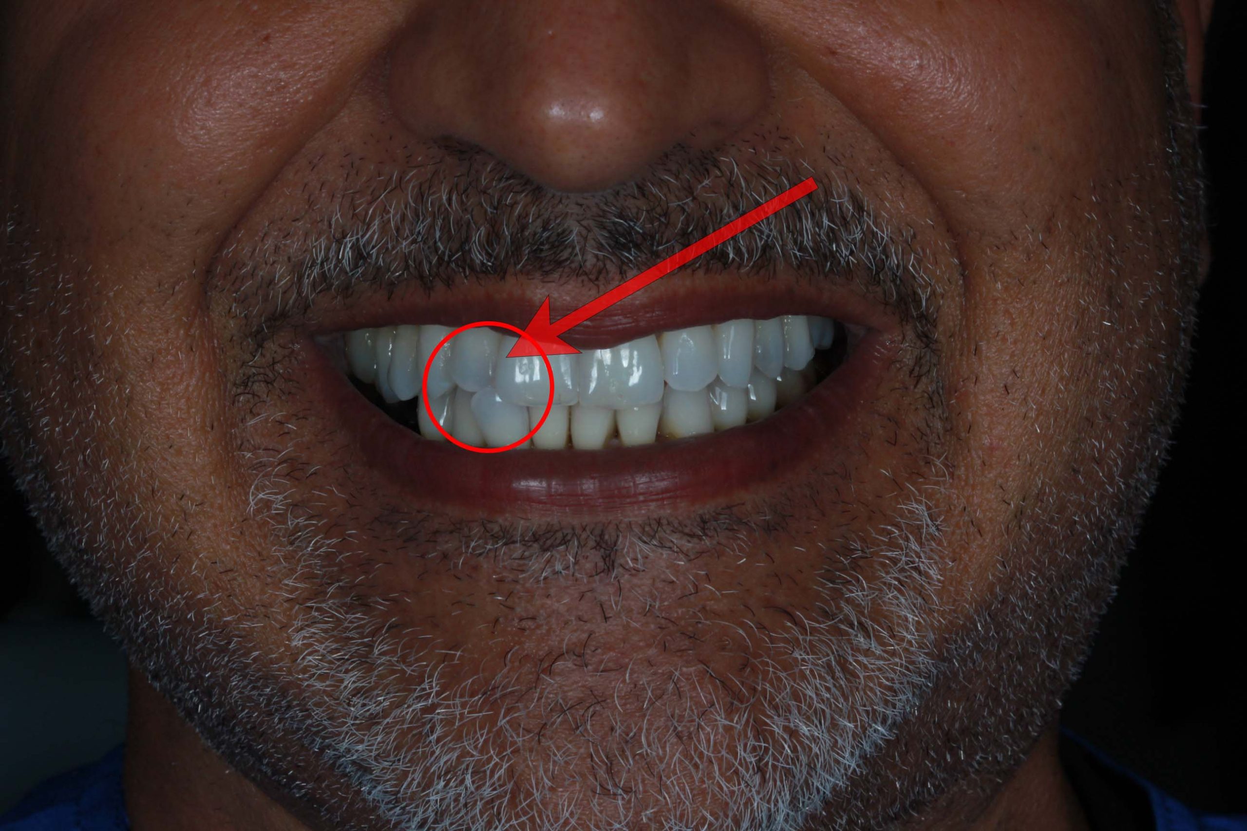 Pre-treatment view showing the crossbite affecting the patient's bite
