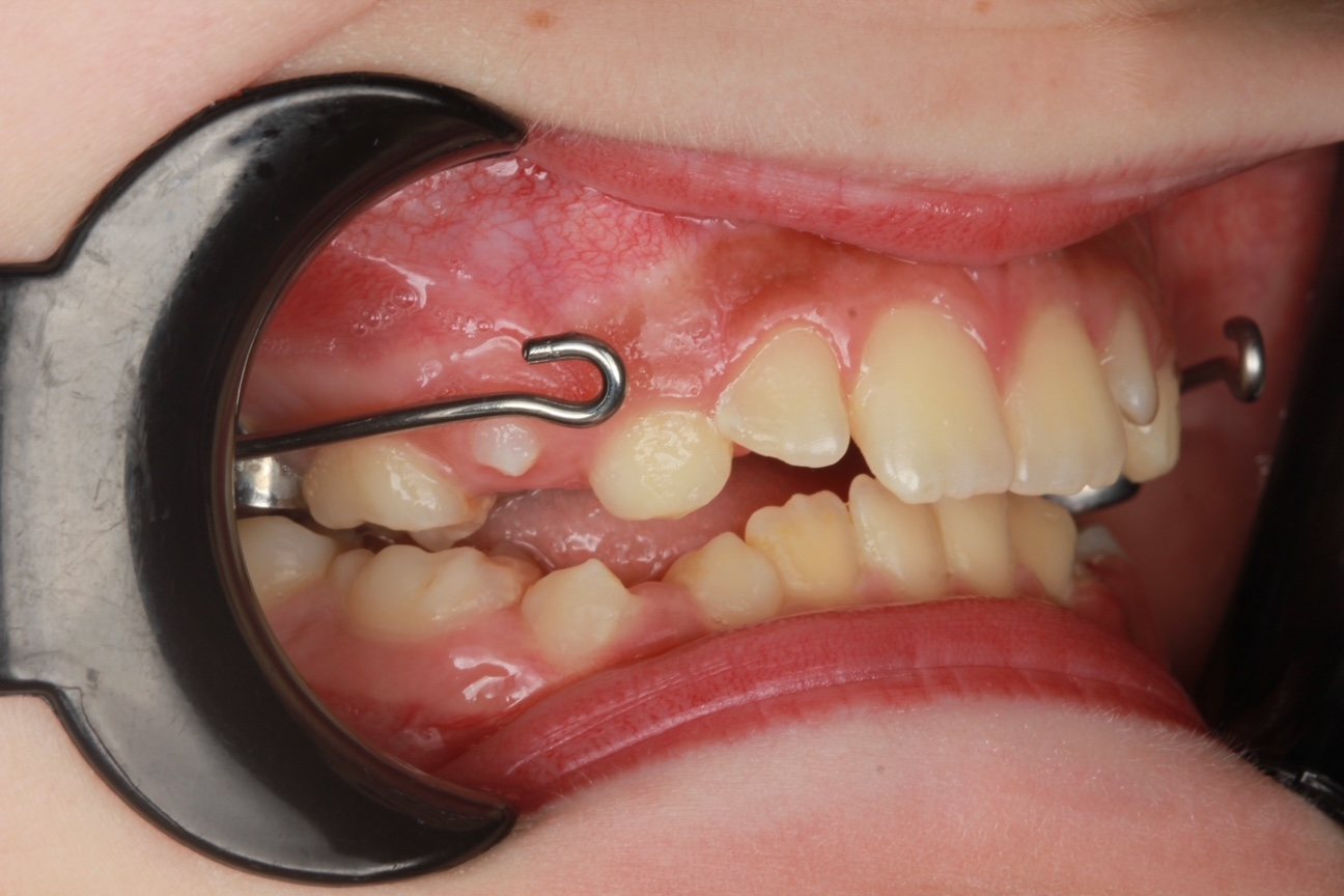 After phase 1 treatment - lateral view with expander and facemask hooks, showing an improved bite