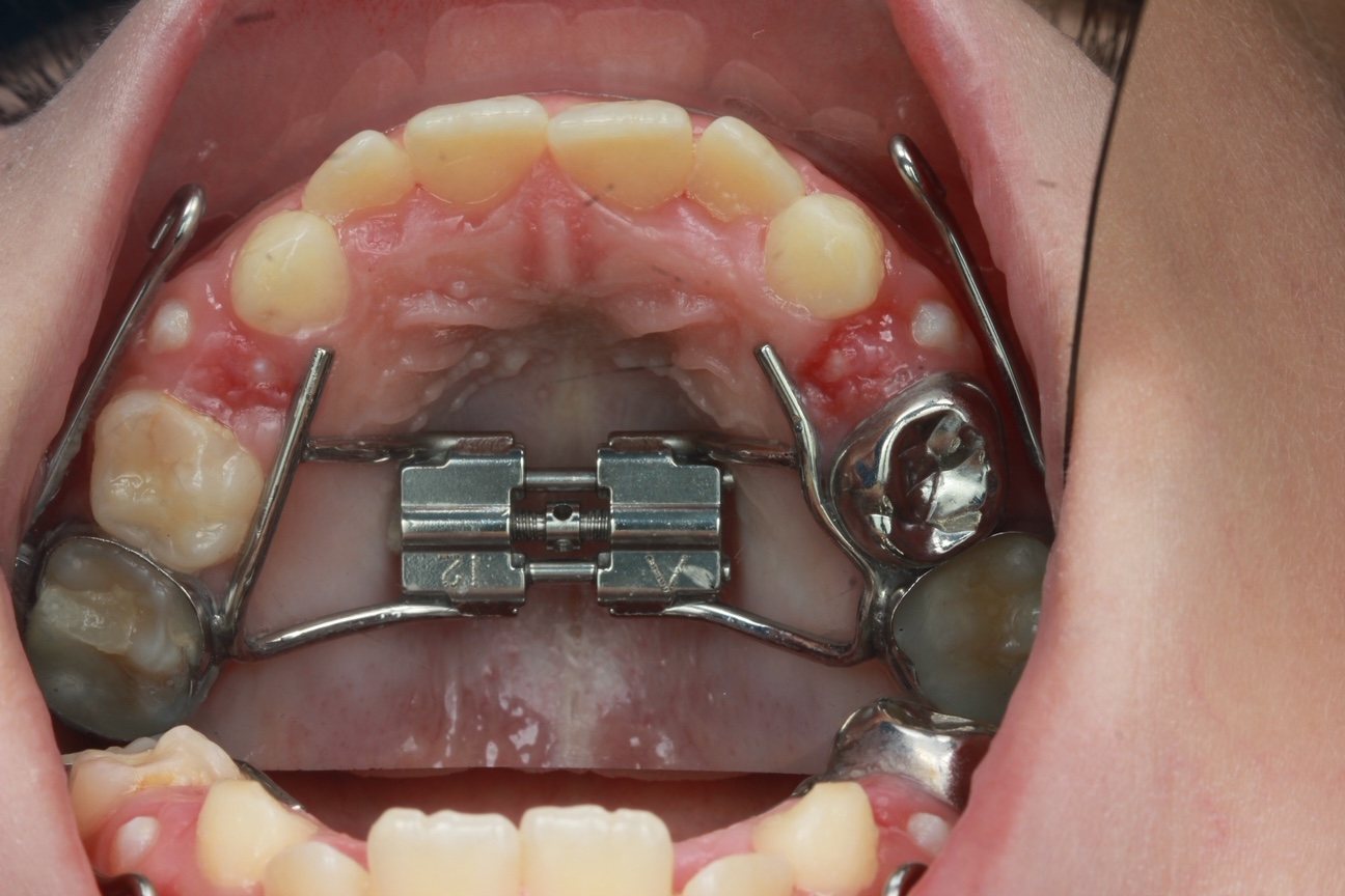 After phase 1 treatment - upper occlusal view of the Hyrax rapid palatal expander and widened upper arch