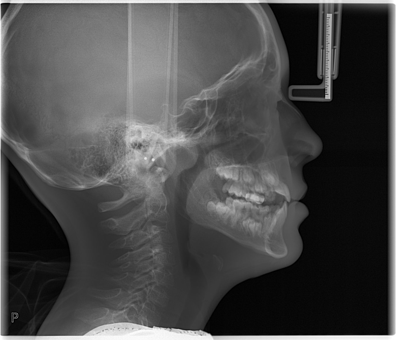 Before treatment - lateral cephalometric X-ray used to assess the skeletal Class III jaw relationship