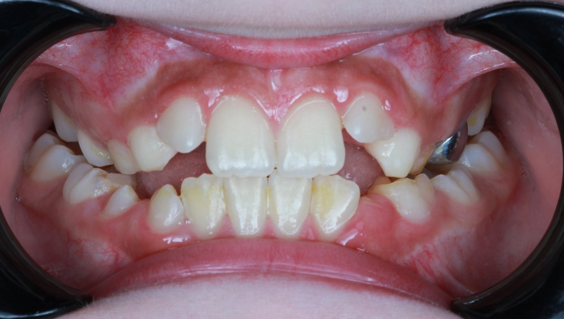 Before treatment - frontal intraoral view of mixed dentition with a narrow upper arch