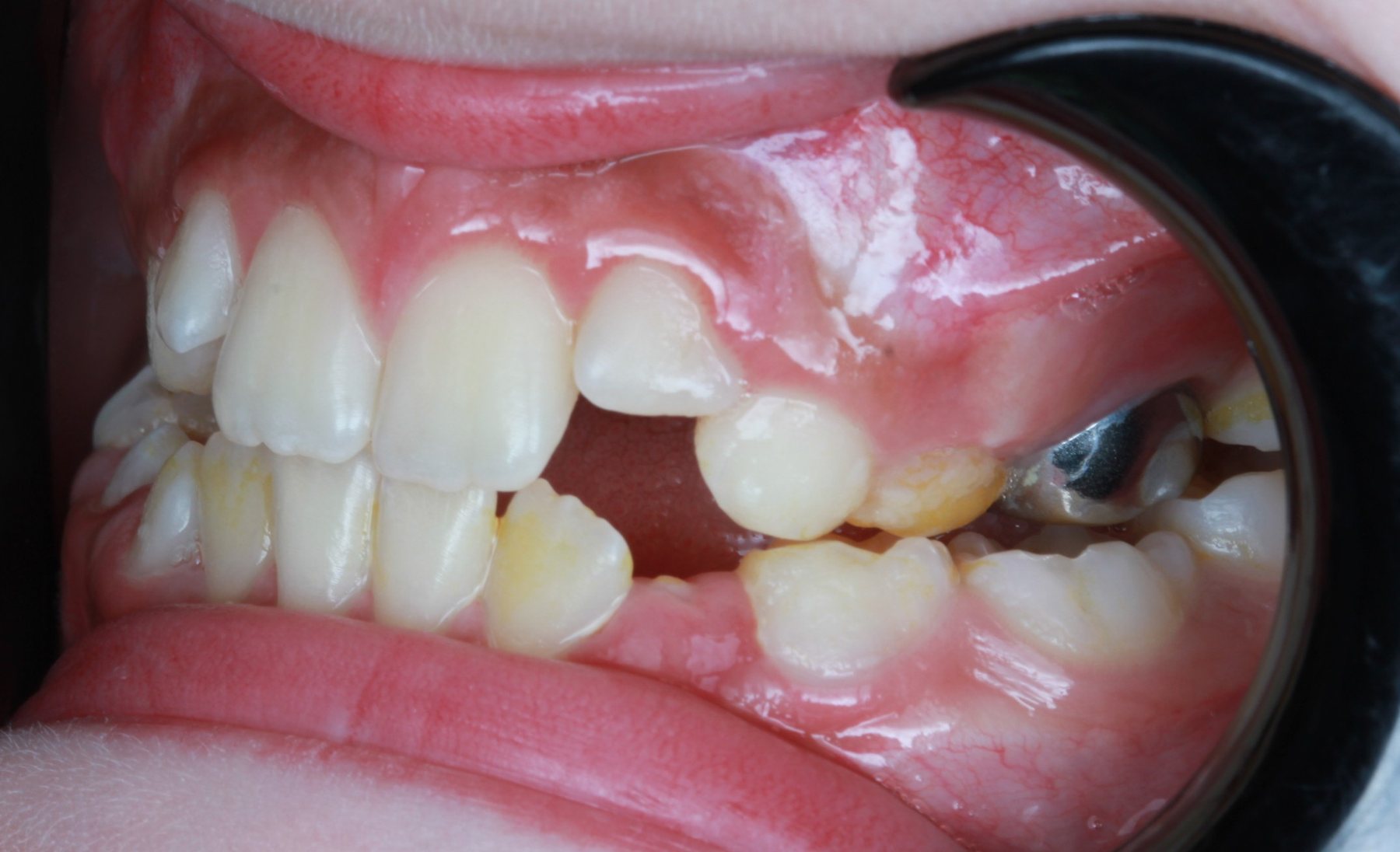 Before treatment - lateral intraoral view showing the posterior crossbite and Class III tendency