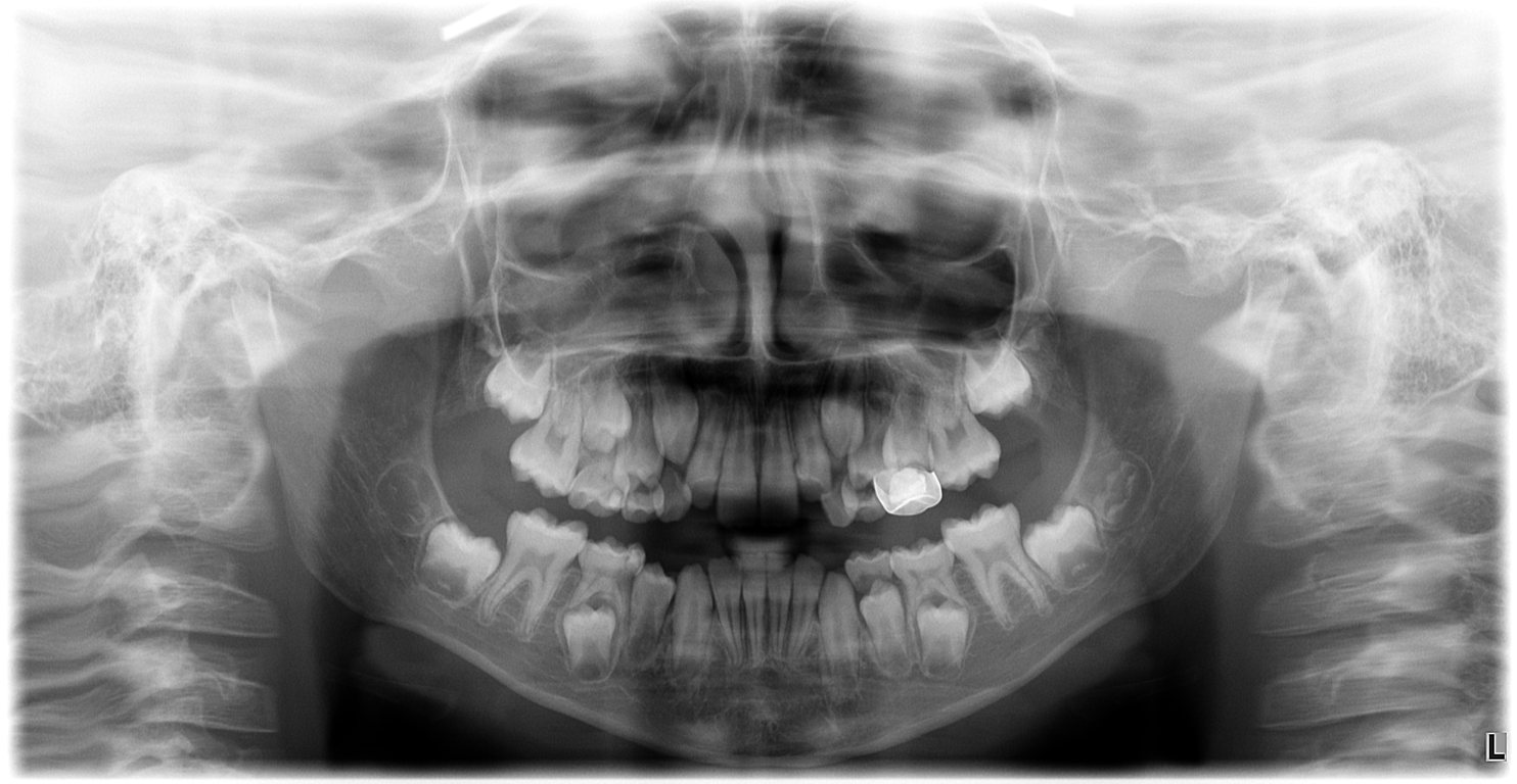 Before treatment - panoramic X-ray showing mixed dentition and developing permanent teeth