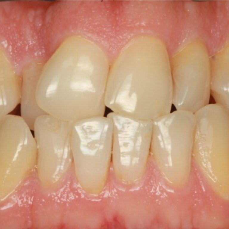 twisted teeth
